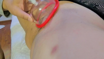 丹夫人系列之鲍鱼拔罐2