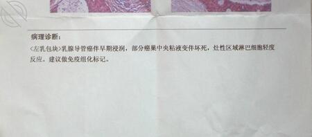 妈妈需要去医院切除乳房0